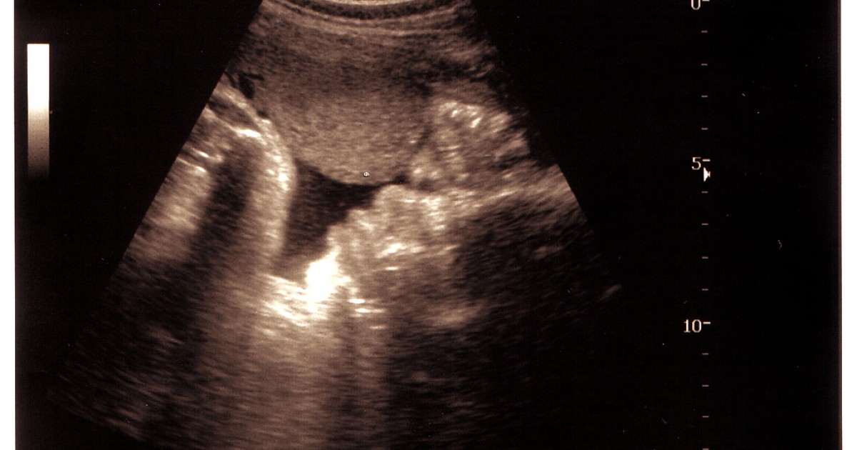 Senate to Vote on 20-Week Abortion Ban