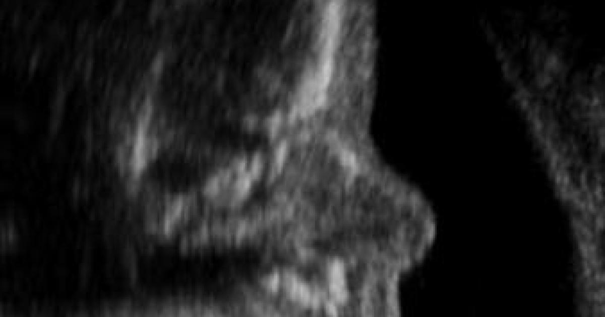 Revisit the Born-Alive Act