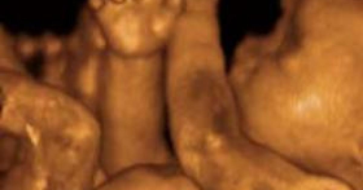 Philadelphia Abortionist Charged for Killing 7 Babies After They Were Born